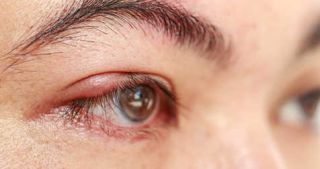 inflammation-paupiere - Soigner l’inflammation des paupières au naturel